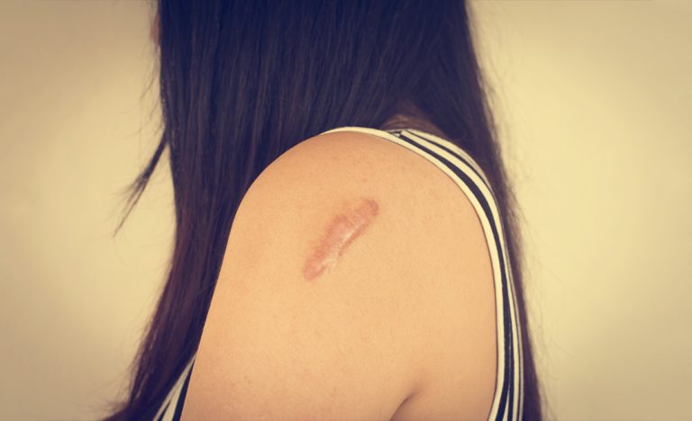 How To Prevent Scarring From A Burn