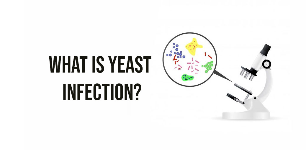 Yeast Infection Description, Causes and Treatment Doctor ASKY
