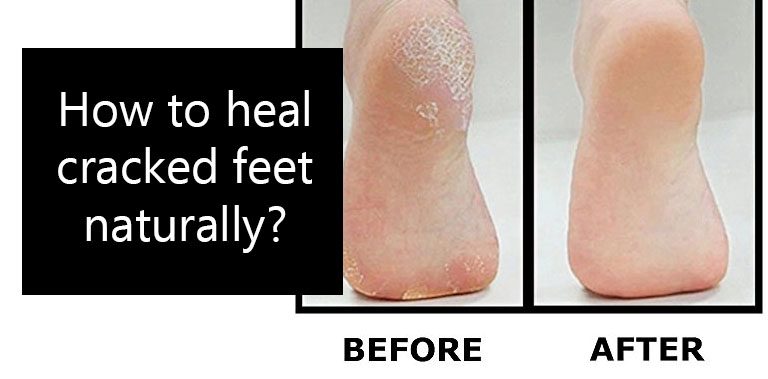 How to heal cracked feet naturally?