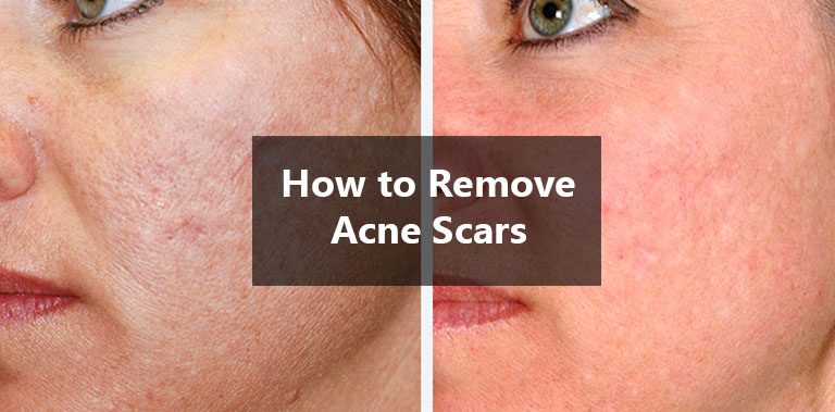 Secrets on How to Remove Acne Scars