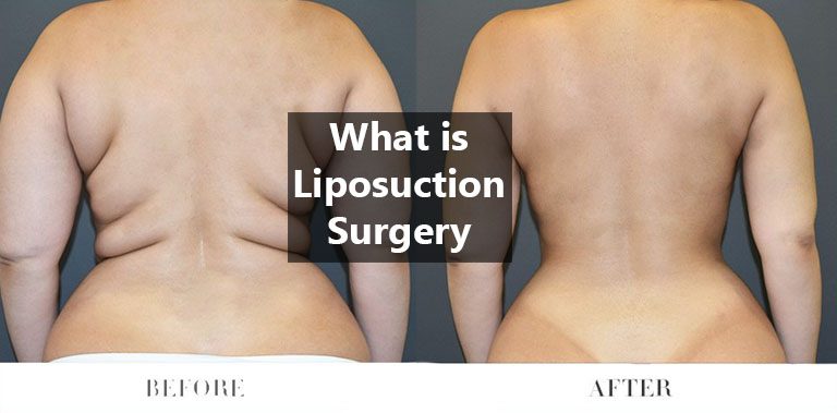 What is Liposuction Surgery