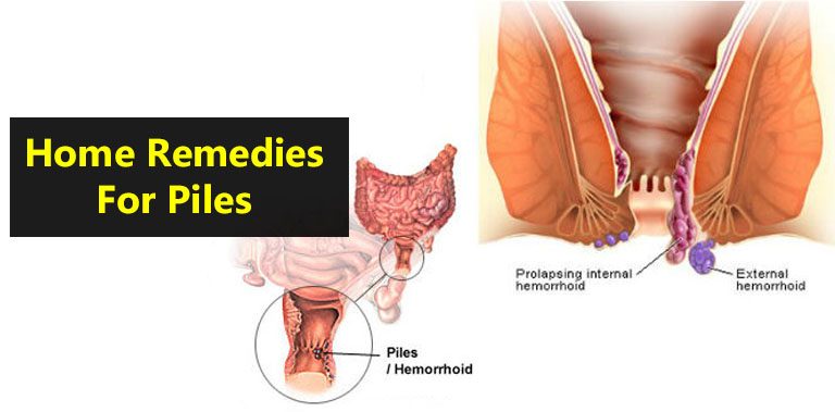 Home Remedies For Piles