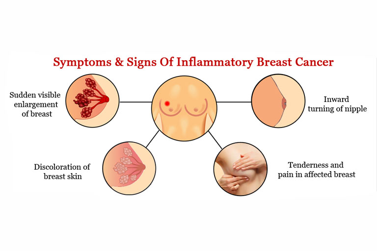 What is Inflammatory Breast Cancer
