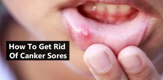 How To Get Rid Of Canker Sores - Doctor ASKY
