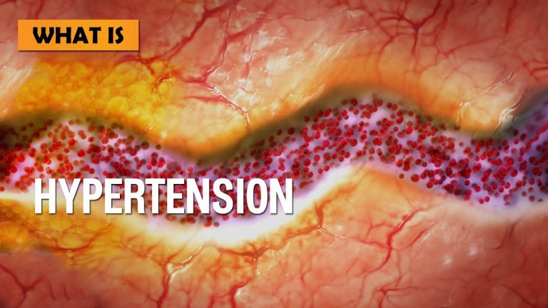What is hypertension, and How to manage it ?