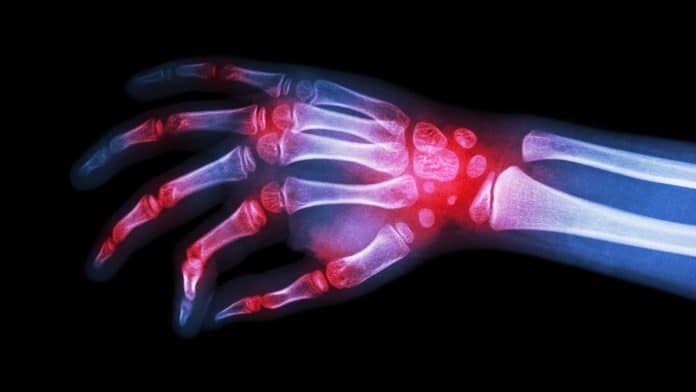 rheumatoid arthritis and GOUT