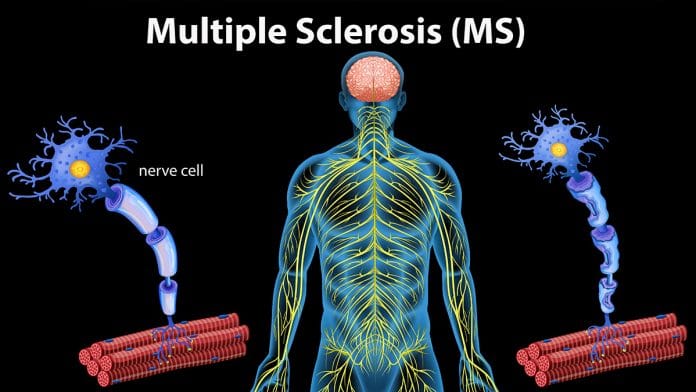 Symptoms Of Multiple Sclerosis.