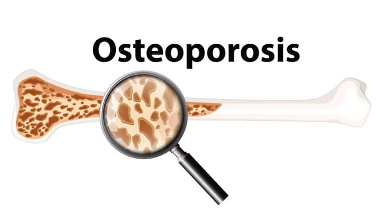 Ways To Prevent Osteoporosis