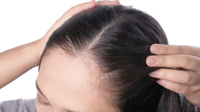 How To Deal With Thinning Of Hair
