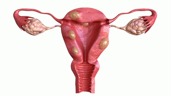 What is Endometriosis?