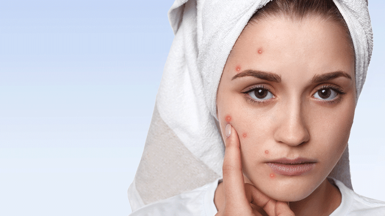 HABITS-THAT-CAUSE-ACNE