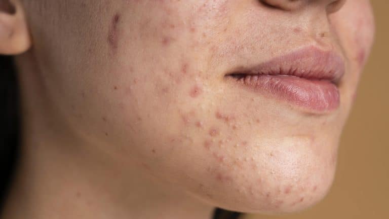 Different Types Of Acne And Their Solutions